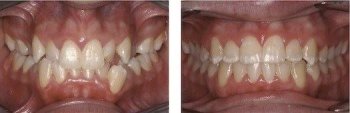 6 months braces before and after pictures. Temecula dentist