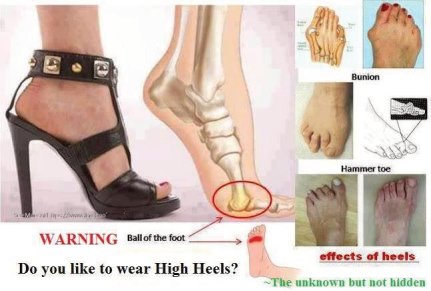 Foot deformities caused by high heels
