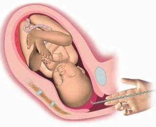 Amniotomy, Artificial Rupture of the Membranes, AROM - Info sheet for Bradley Method® natural childbirth classes offered in Arizona: Chandler, Tempe, Ahwatukee, Gilbert, Mesa, Scottsdale, Payson