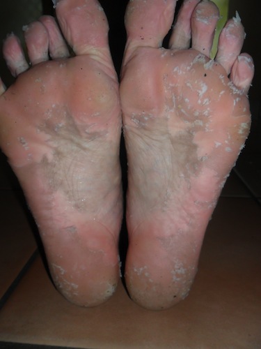 Dead Skin Acid Peel for your feet. (Kitchen Cabinet Remedy!)