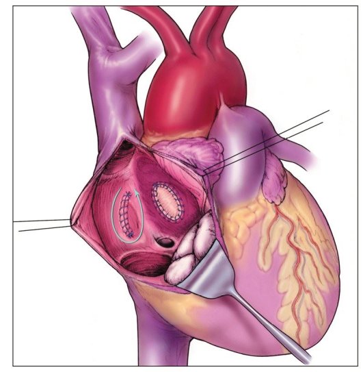 Atriotomy suture lines and patch closure of atrial septal defects.