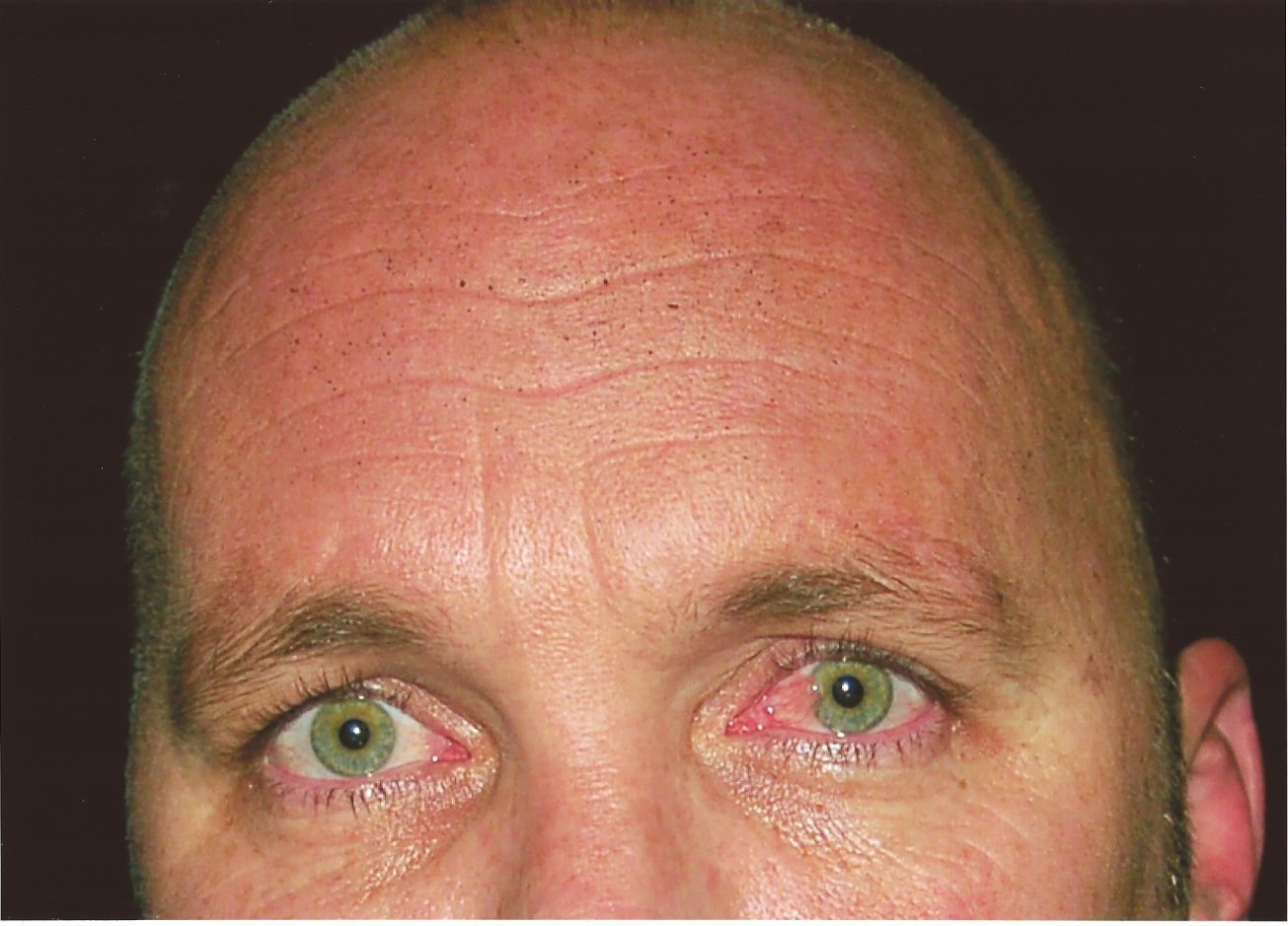 Close up forehead GSR crime scene photo