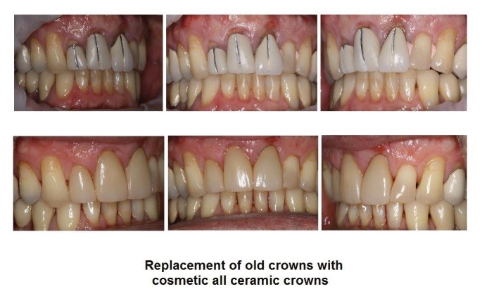 Cosmetic all ceramic crowns for a great smile