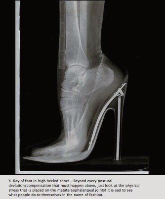 X-ray of highly stressed foot caused by high heeled shoe...